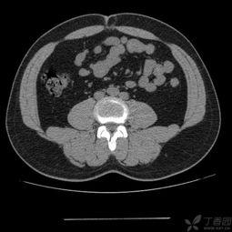 成人脐疝小妙招视频教程,成人脐疝小妙招视频教程解析