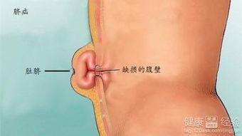 成人脐疝小妙招视频教程,成人脐疝小妙招视频教程解析