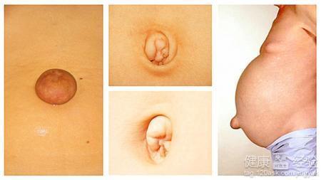 成人脐疝小妙招视频教程,成人脐疝小妙招视频教程解析