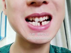 成人正畸步骤视频教程,从咨询到矫治完成