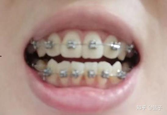 成人正畸步骤视频教程,从咨询到矫治完成