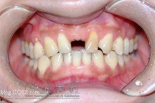 成人正畸步骤视频教程,从咨询到矫治完成